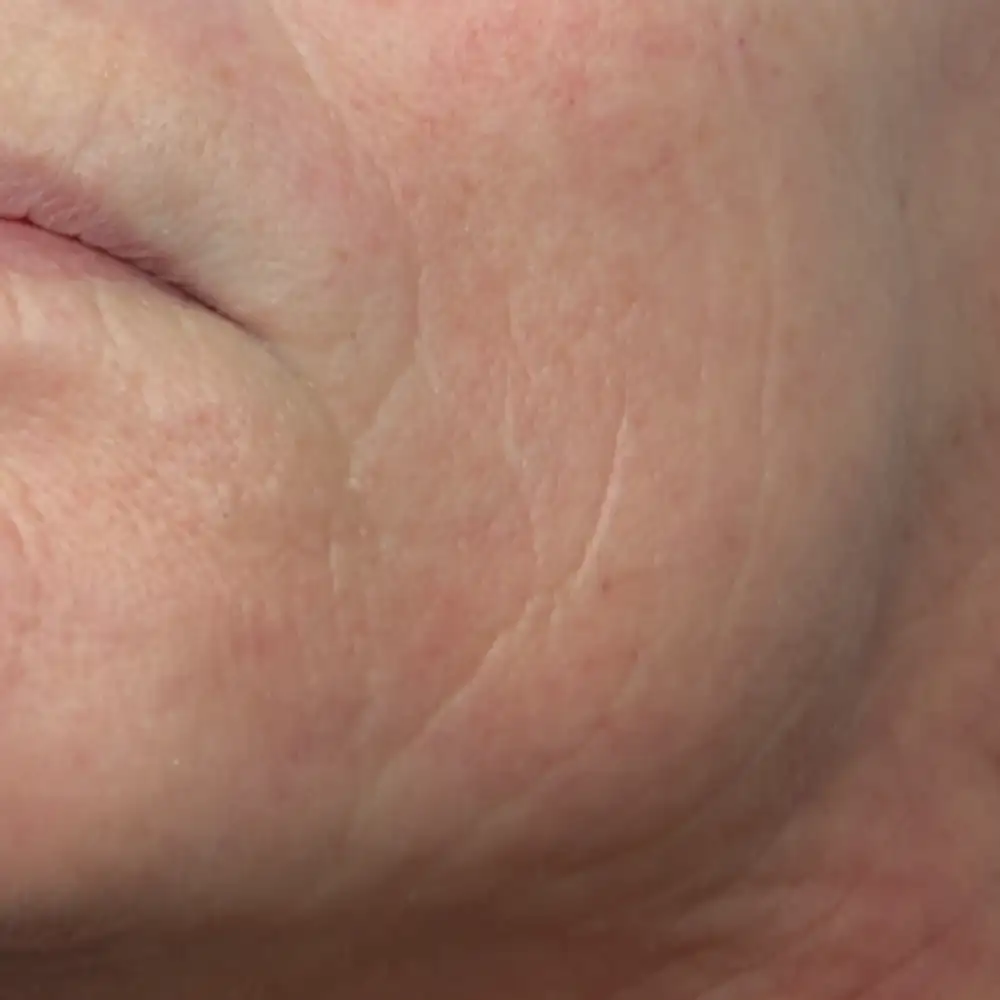 Pred ošetrením: Retinol - efekt nestarnúcej pleti (Longevity) – Klientka, 57 r. — po 1 sedení