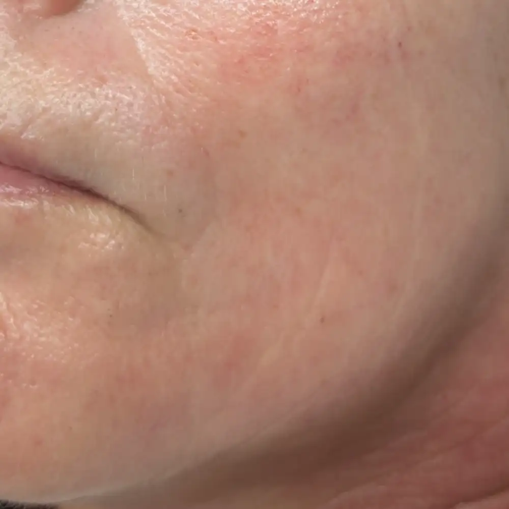 Po ošetrení: Retinol - efekt nestarnúcej pleti (Longevity) – Klientka, 57 r. — po 1 sedení